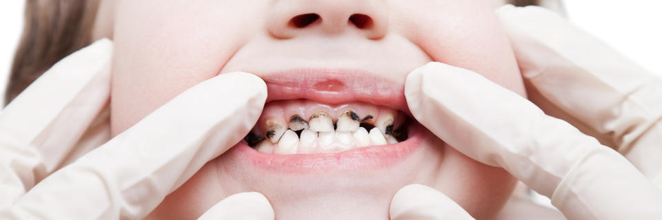 Детские кариес: кариес молочных зубов